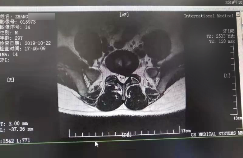 三秦網(wǎng)報(bào)道—西安國際醫(yī)學(xué)中心骨科醫(yī)院成功完成首例椎間孔鏡手術(shù)