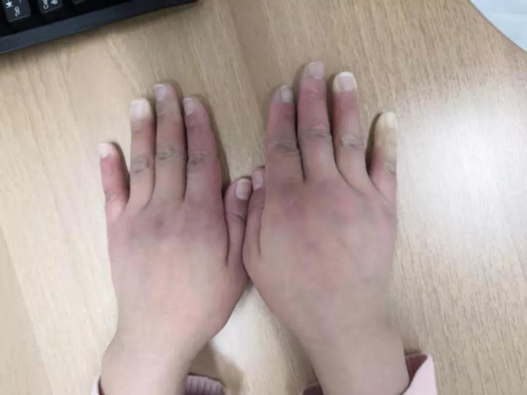 “手指、腳趾發(fā)白、發(fā)紫……”這些“小毛病”千萬別大意