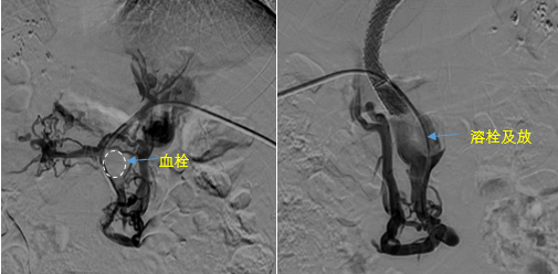 血栓攔路，如何破局——罕見巨大門靜脈血栓TIPS手術(shù)實(shí)錄