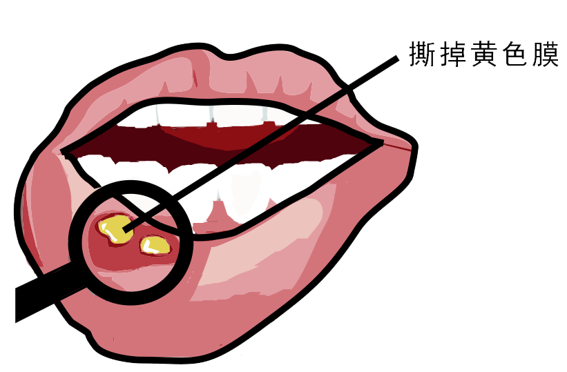 經(jīng)常口腔潰瘍，真的只是缺維生素嗎？