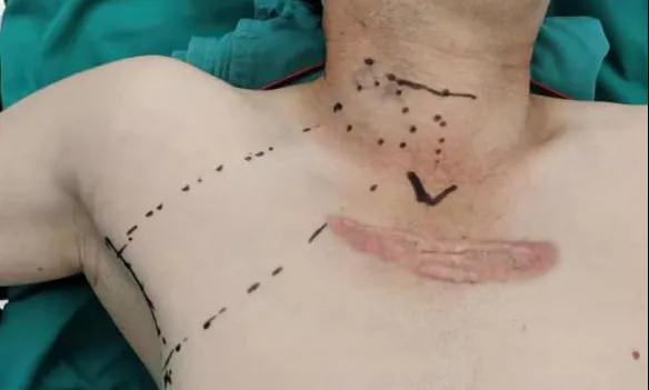 術(shù)后傷口可以“隱身”嗎？