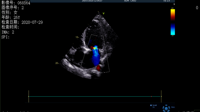 心電圖異常，心臟卻沒事，罪魁禍首是……