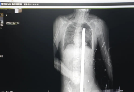 1.2米長(zhǎng)的鋼筋貫穿男子胸腹！情況極度危險(xiǎn)......