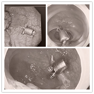 消化病醫(yī)院內(nèi)外科聯(lián)合開(kāi)展3例“磁環(huán)預(yù)標(biāo)記輔助腹腔鏡結(jié)、直腸癌根治術(shù)”