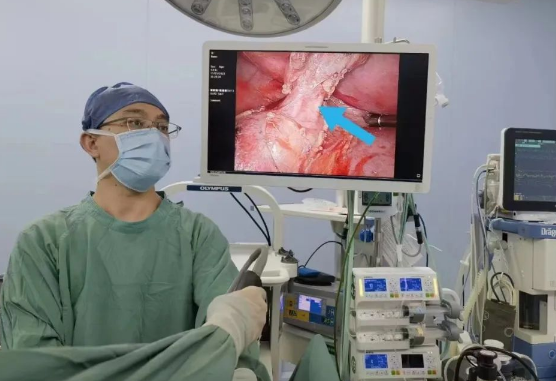 30歲小伙持續(xù)發(fā)燒咳嗽，原來是多長一塊肺......