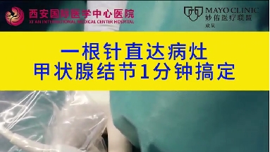 1根針直達病灶 甲狀腺結節(jié)1分鐘搞定
