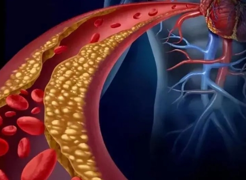 警惕！冠脈支架術(shù)后這些誤區(qū)千萬別踩，趕緊收藏！