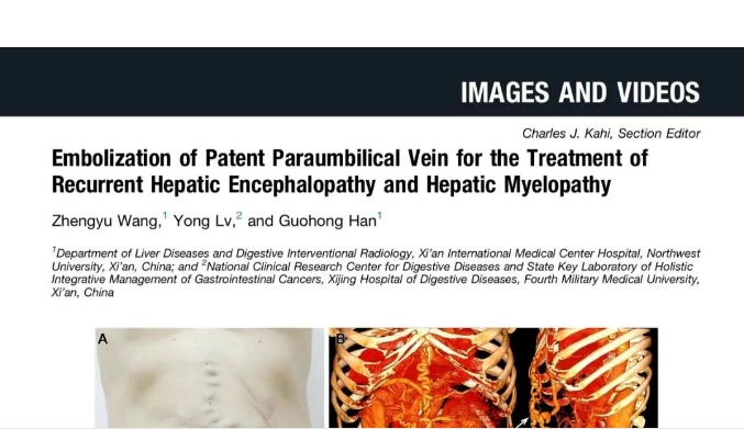 我院護(hù)理團(tuán)隊(duì)臨床成果登榜國(guó)際肝病權(quán)威期刊，影響因子11.6